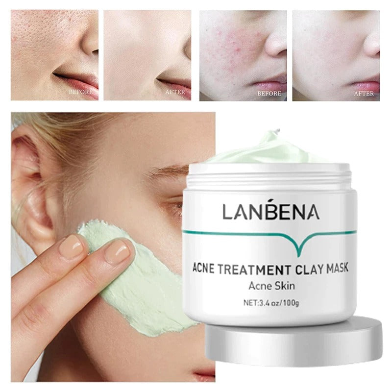 Lanbena Acne Treatment Clay Mask 100G